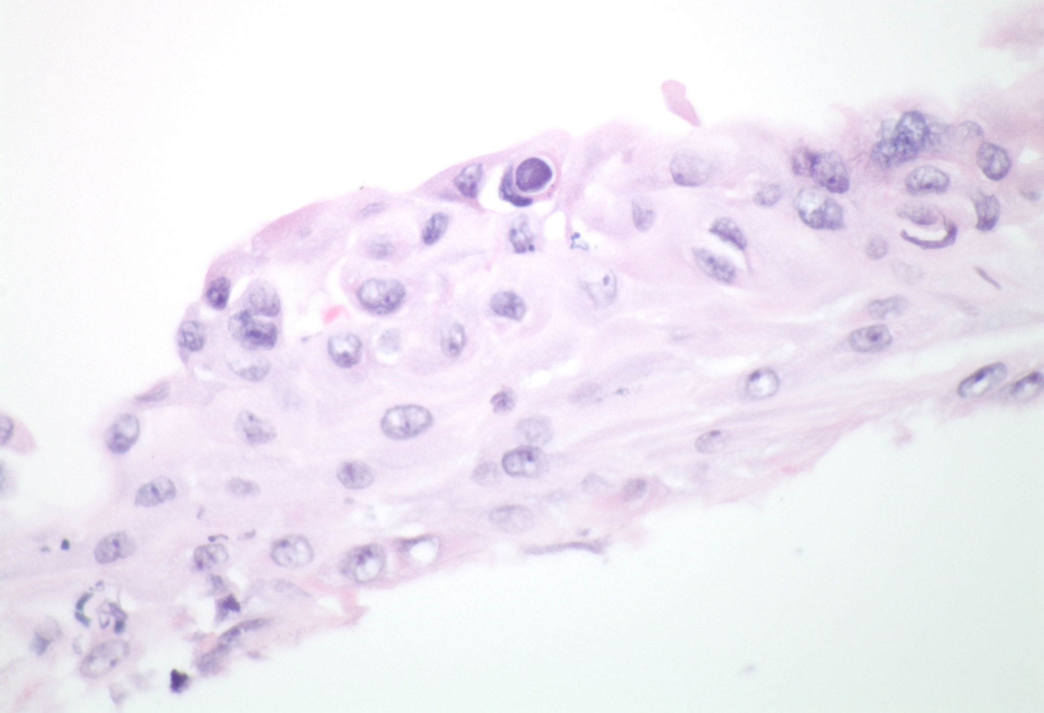 H&E stain demonstrates a classic example of the double-walled cyst structure of Acanthamoeba.
